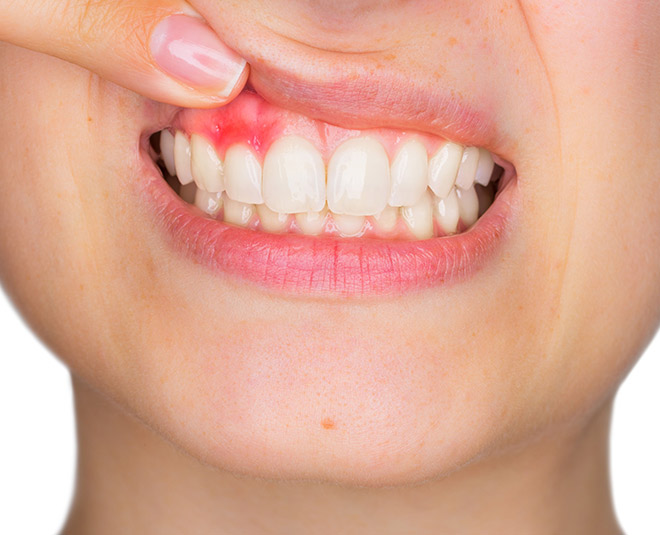 bleeding-in-gums-try-these-ayurvedic-home-remedies-in-hindi-bleeding