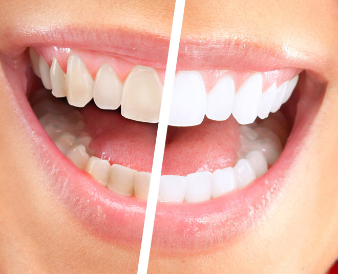 tooth whiting product card ()