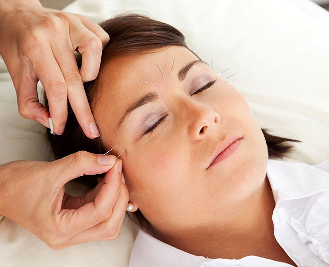 acupuncture therapy for sleep inside 