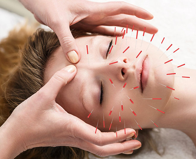 acupuncture therapy for sleep inside 