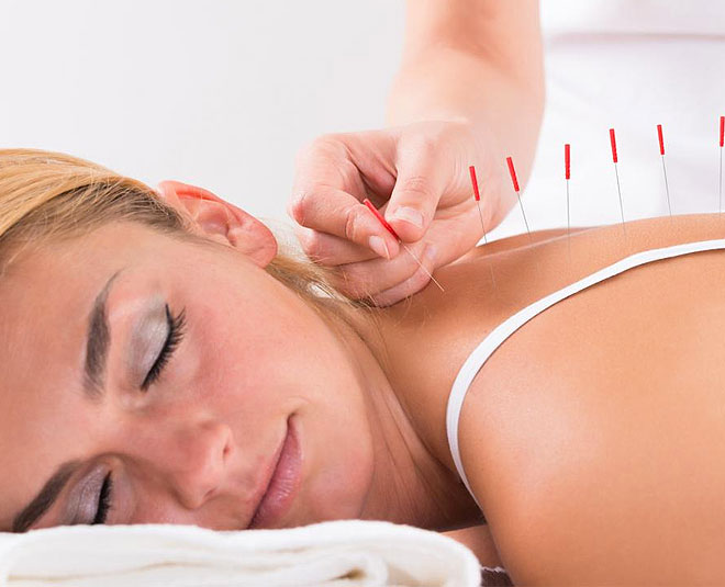 acupuncture therapy for sleep inside 