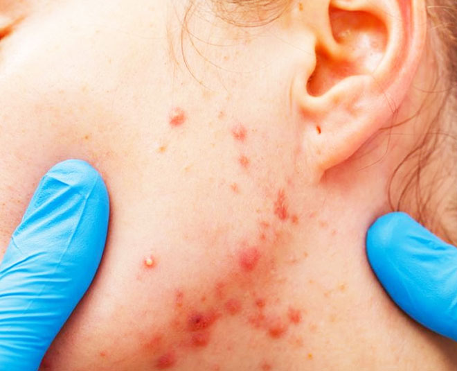 common side  effects of anti biotics that  you inside 