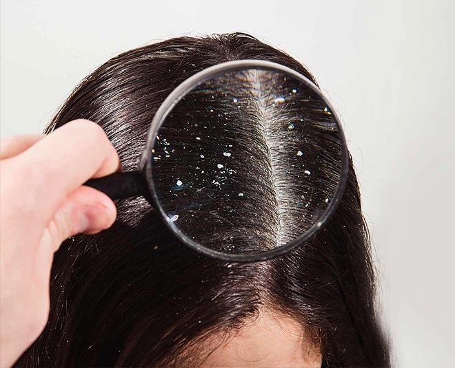 neem for dandruff treatment