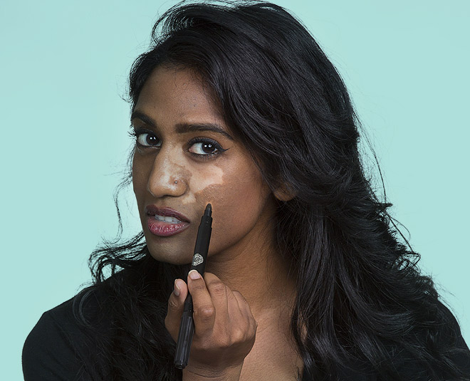 vitiligo facts  causes inside 