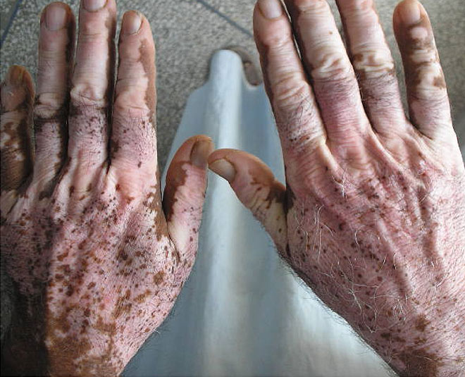 vitiligo facts  causes inside 