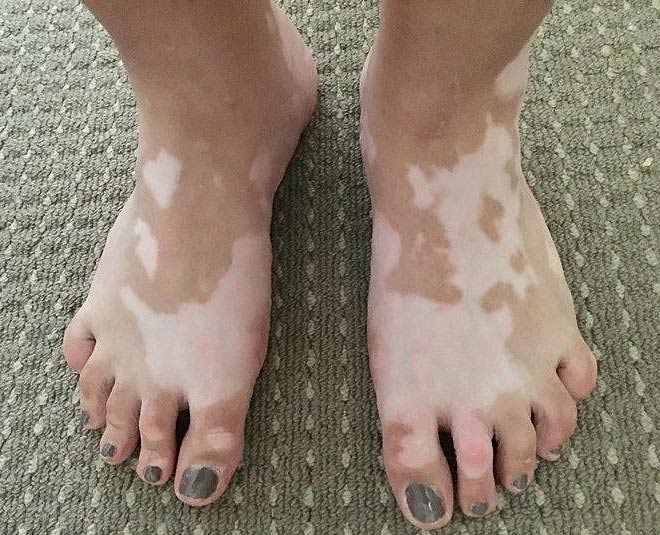 vitiligo facts  causes inside 