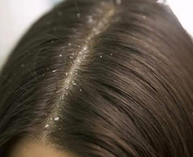 Winter Hair Care Tips: Garlic for Dandruff Cure