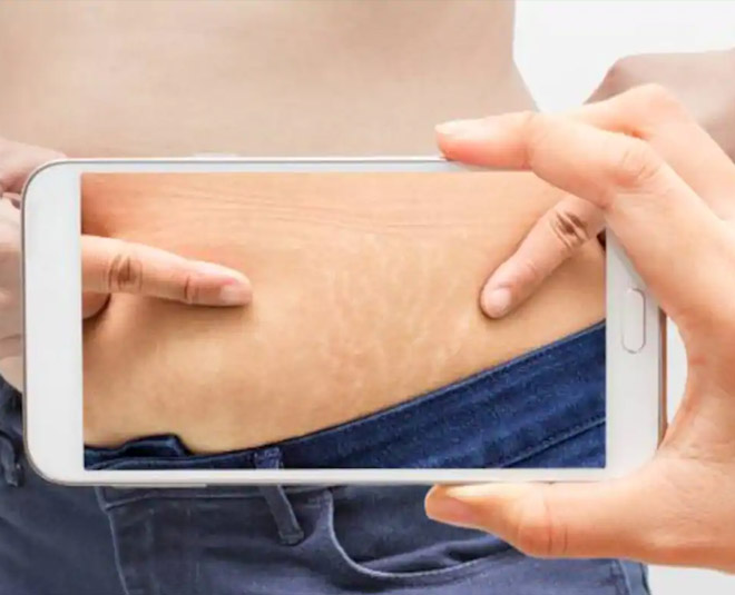 how to remove stretch marks fast INSIDE 