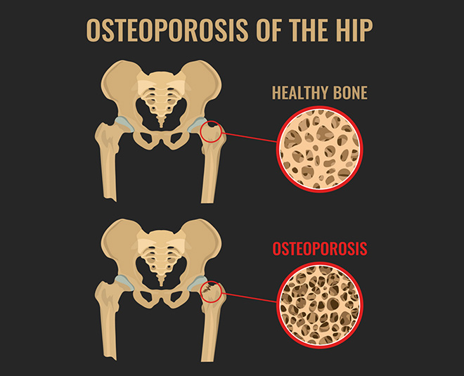 osteoporosis health card ()