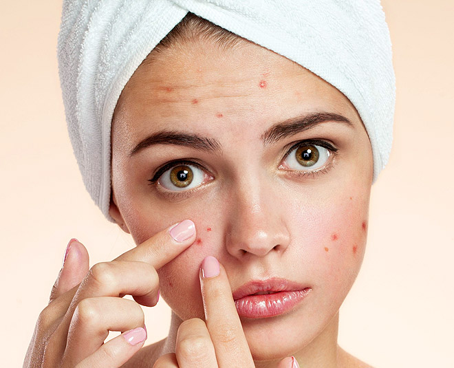 prevent acne chironji