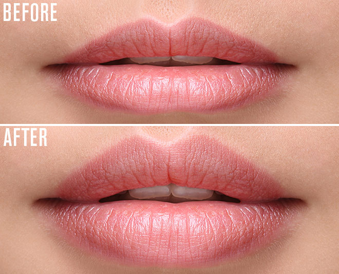 Planning For Lip Fillers? These 7 Points You Should Keep In Mind ...