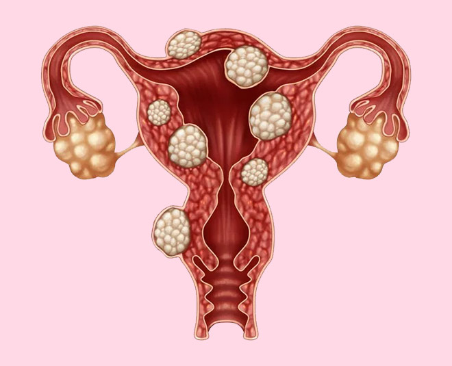 fibroid health inside 
