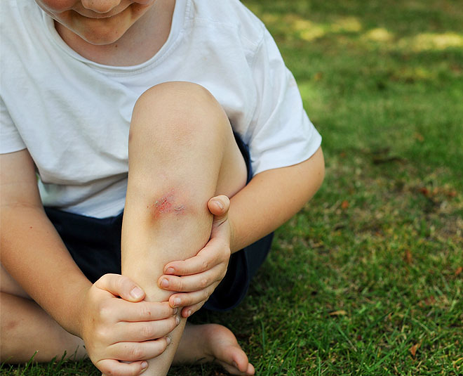 How to Get Rid of Bruises: 10 Remedies
