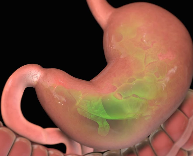 stomach problem acid reflux INSIDE 