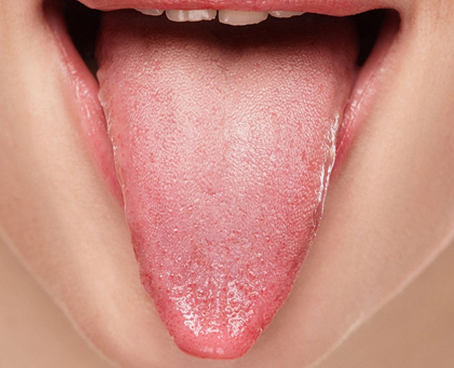 5-home-remedies-to-get-rid-of-tongue-ulcer-5-home-remedies-to-get-rid