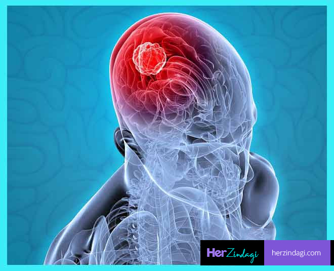 Brain Tumor Can Be Cancerous Know How World Brain Tumor Day 2019