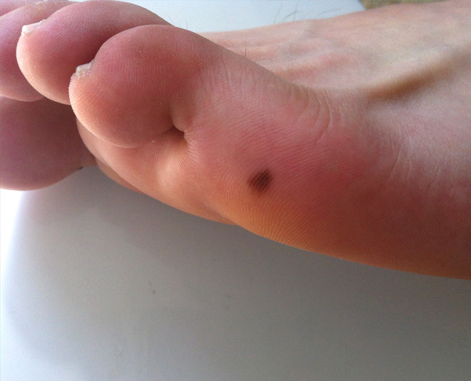 Mole On Small Toe Meaning