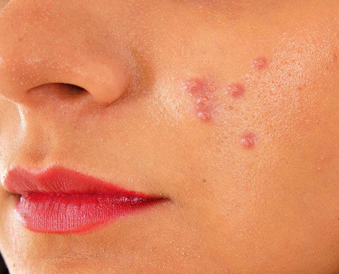 pimples problem mango