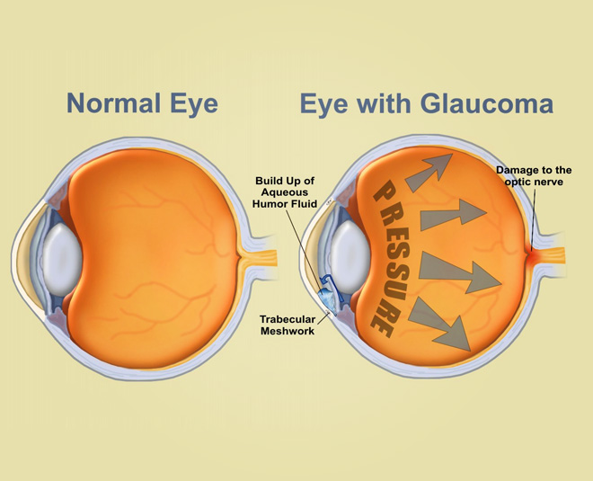 Glaucoma Awareness: Common Myths, Symptoms And Treatment | HerZindagi