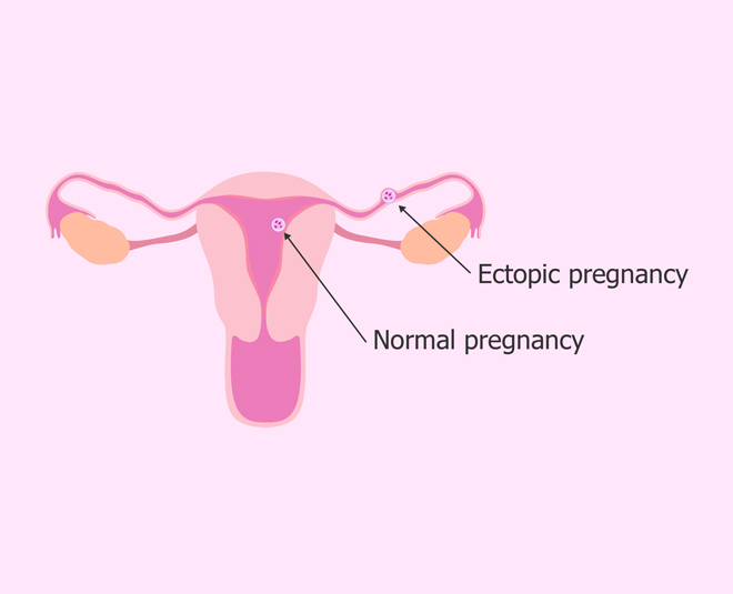 ectopic pregnancy inside 