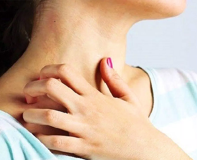 Use Some Home Remedies To Get Rid From Prickly Heat