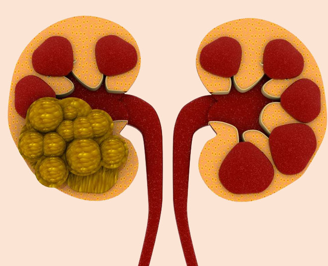 kidney stones muskmelon