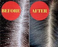 ayurvedic hair pack for dandruff