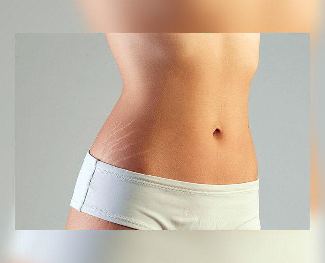 shea butter for stretch marks