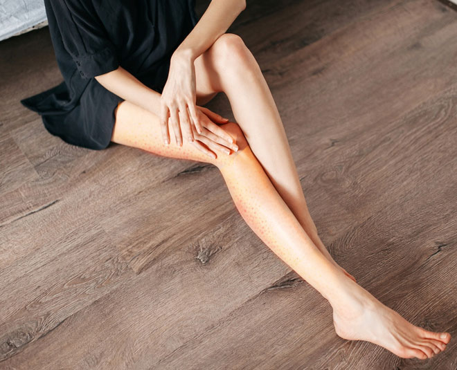 strawberry legs reasons