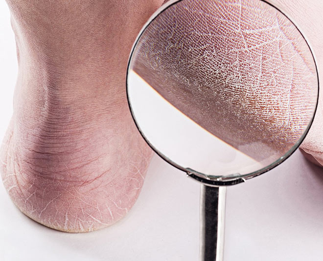 best oil for dry cracked feet