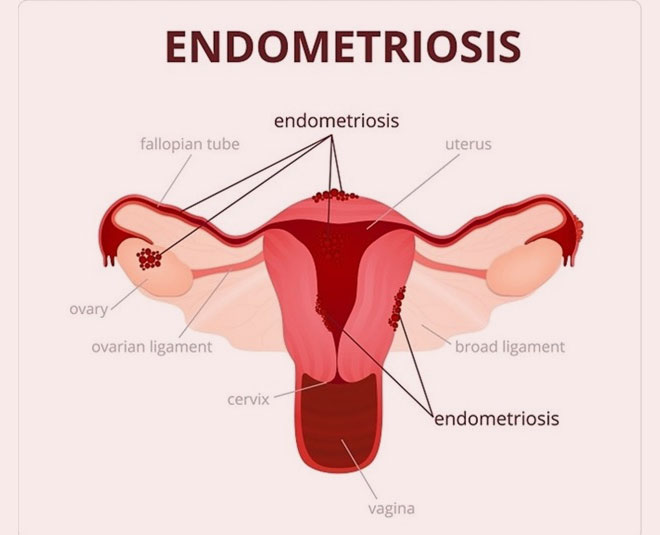 abnormal tissue in uterus