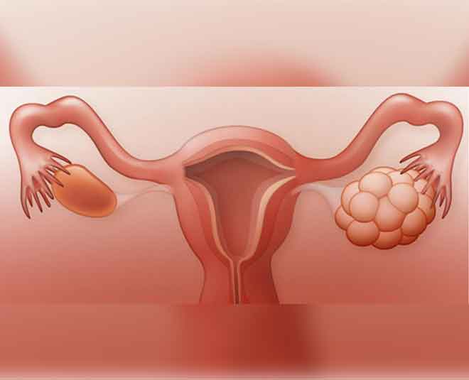 getting pregnant with pcos