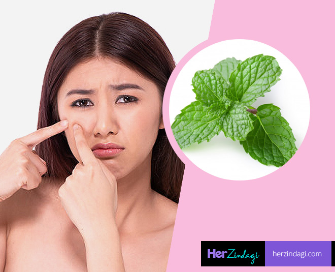 3-amazing-tips-gharelu-nuskhe-of-mint-or-pudina-to-get-rid-of-acne