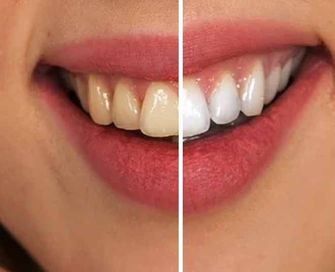 teeth stains stained ayurvedic clean those dietary ayurveda natural rid them solutions using