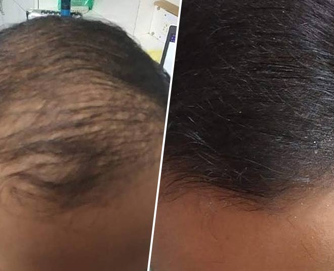 Gharelu Nuskha to Regrow Hair on Bald Head by Rujuta Diwekar | gharelu  nuskha to regrow hair on bald head by rujuta diwekar | HerZindagi