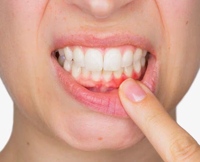 home remedies for bleeding gums tips