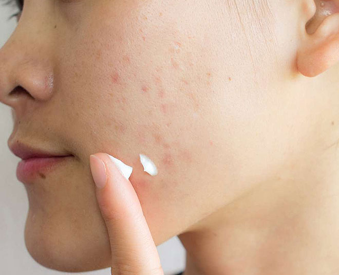 product that can remove acne scars