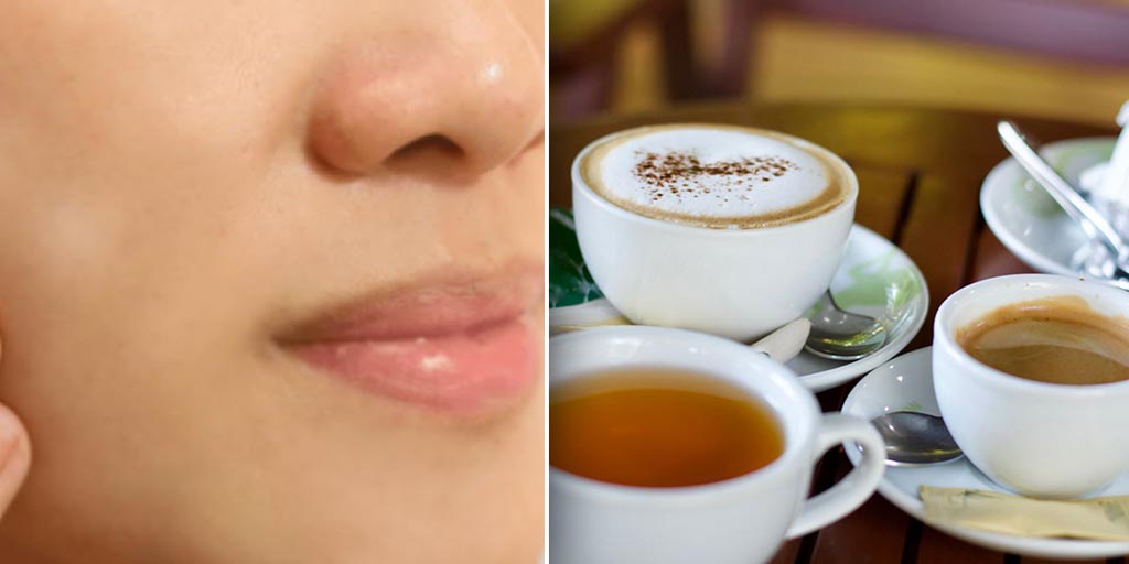 Avoid Getting White Spots Or Vitiligo By Reducing Tea, Coffee, Fried