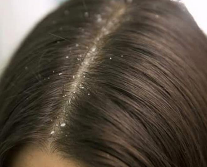 dandruff problem hair care inside