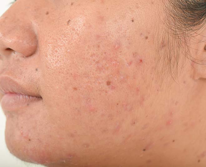 How To Get Rid Of Old Acne Scars HerZindagi