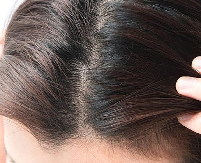 Know About Some Home Remedies For Scalp Acne in Hindi | know about some home  remedies for scalp acne in hindi | HerZindagi