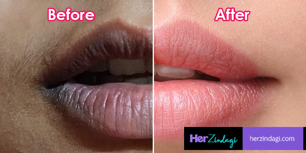 How To Get Rid Of Black Lips Naturally How To Get Rid Of Black Lips Naturally Herzindagi