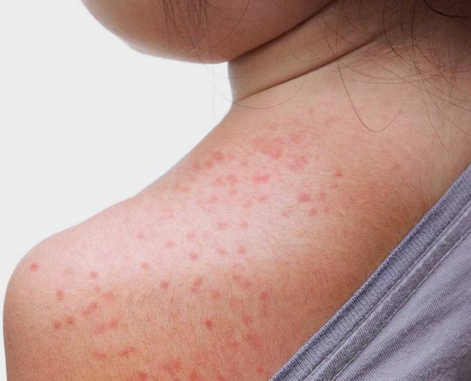 How to get rid of heat rash: Relieve redness and itchiness by