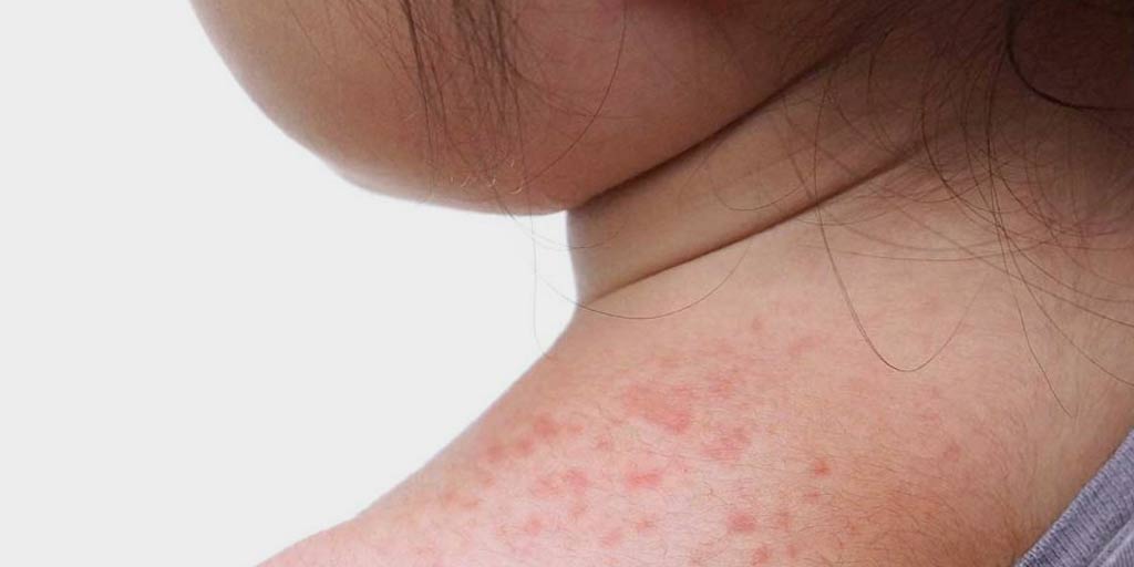 Suffering From Sweat Rashes? These Home Remedies Will Cure & Soothe You