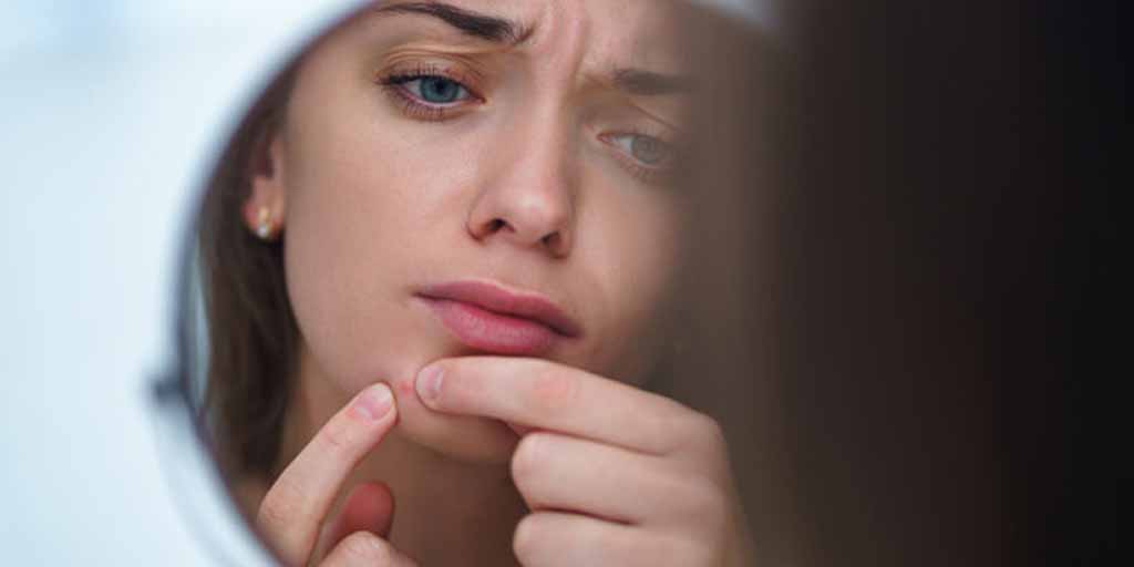 Here’s Everything You Need To Know About Stress Acne Stress Acne Is