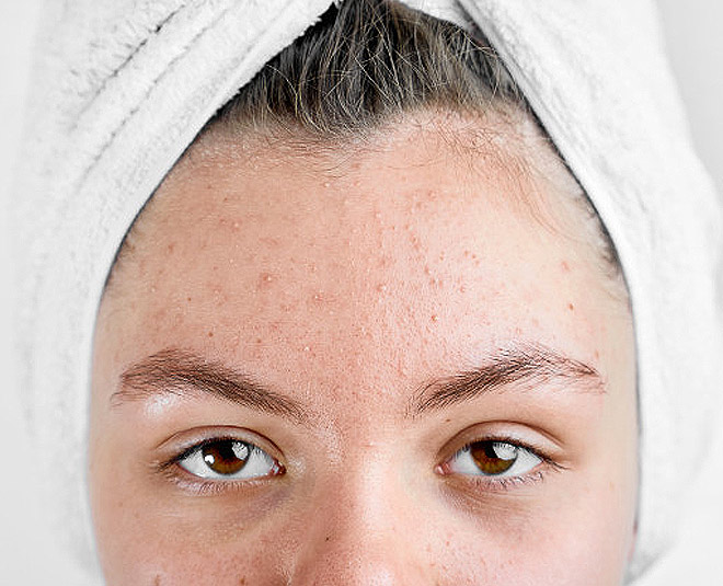 acne prone skin care products