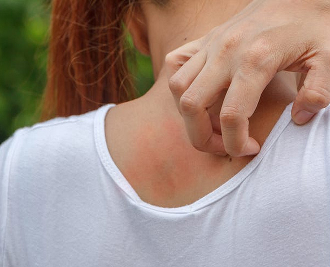 home remedies for mosquito bites m