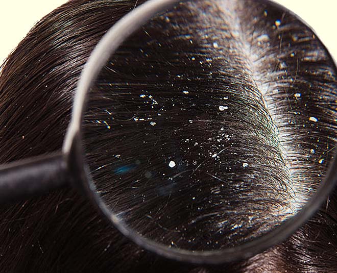 amla powder and oil for dandruff