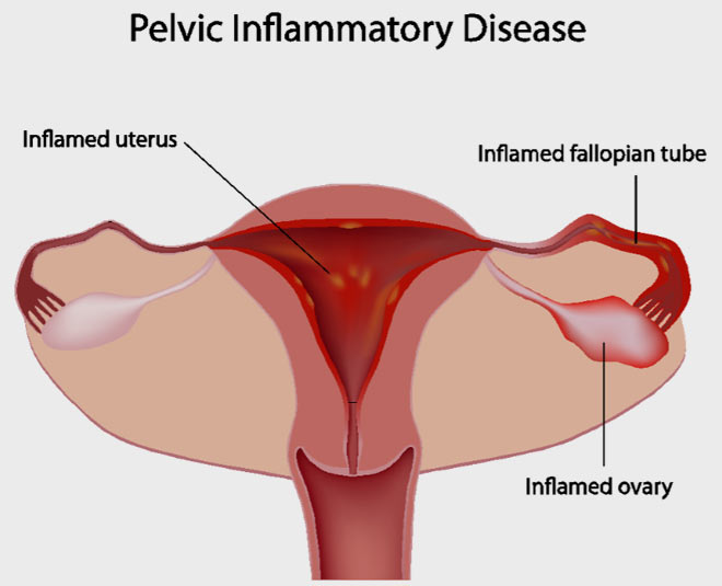 basic symptoms of pelvic diseases
