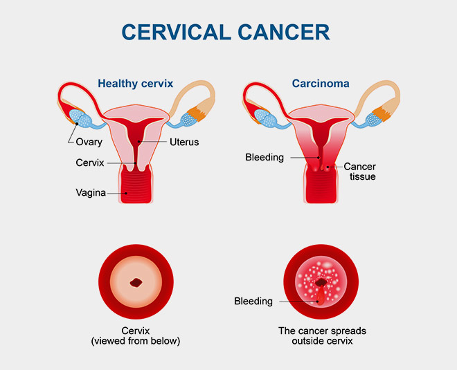 cervical cancer INSIDE 